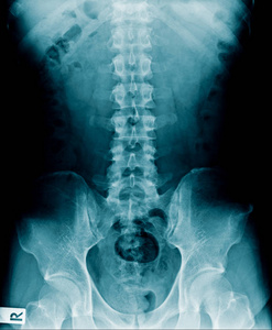 高质量的人脊柱X线显示腰椎退行性改变和胸椎及骨盆轻度颈椎病