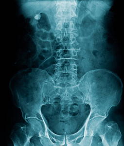高质量的人脊柱X线显示腰椎退行性改变和胸椎及骨盆轻度颈椎病