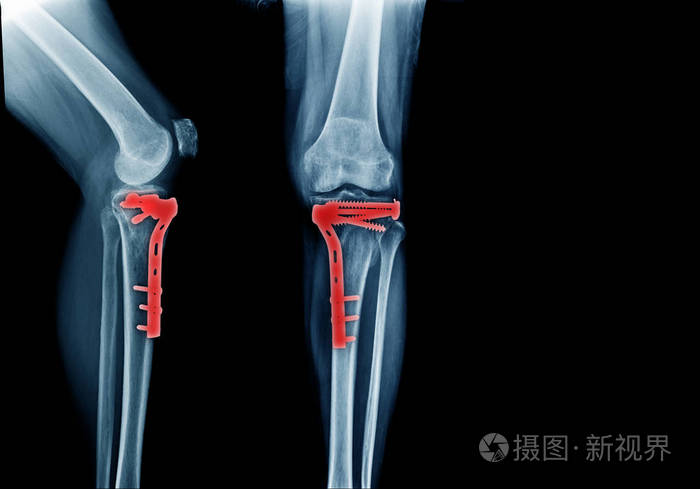 胫骨骨折及术后固定前后x线透视照片 正版商用图片164env 摄图新视界