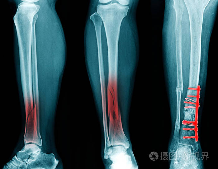 X线胫骨腓骨骨折内固定术后照片 正版商用图片164f8f 摄图新视界