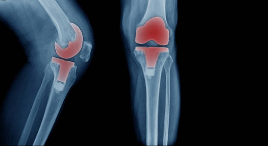 蓝色X射线全膝关节置换术