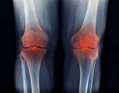 骨关节炎膝关节X线图像高质量oa膝关节pa视图