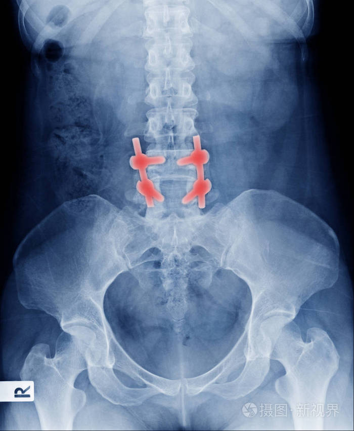 腰椎骨折固定后青年男子x线下背部l45椎体压缩性骨折并术后