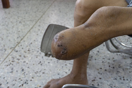 膝下截肢术后糖尿病患者左残端闭合年轻的亚洲女孩在家中痛苦的腿骨骼