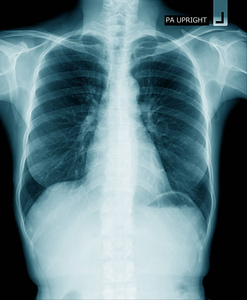 胸部X线高质量肺X线