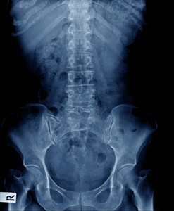 腰椎病合并脊柱侧凸退行性变伴脊柱侧弯