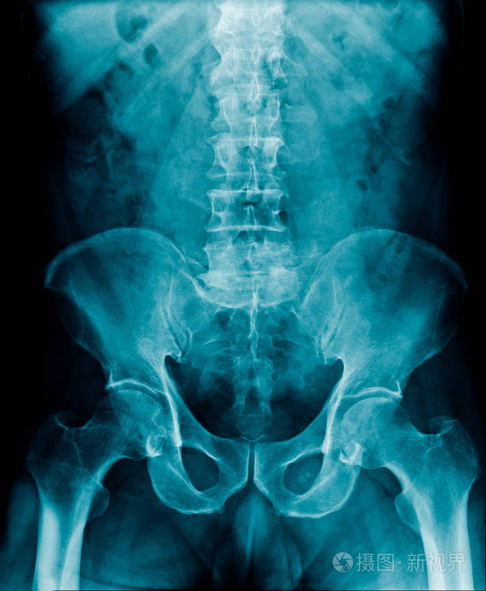 高质量x射线腰椎在蓝调xrau老人图像显示脊椎病或退行性变及部分髋