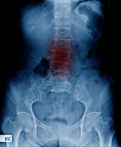 腰椎峡部x射线图像背部疼痛老人表现为轻度脊柱侧弯和椎间盘退变