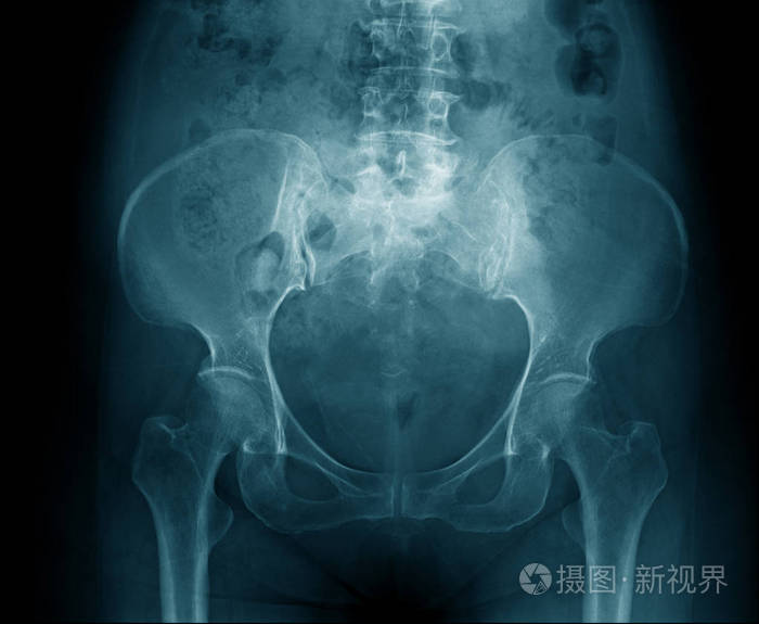 在灰色的背景上骨盆及股骨部分高质量骨盆及髋关节伴部分腰椎及胸位