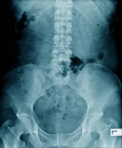 高质量X射线腰椎在蓝调Xrau老人图像显示脊椎病或退行性变及部分髋关节和骨盆骨