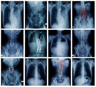 大收集背部和盆腔X射线高质量的X射线集