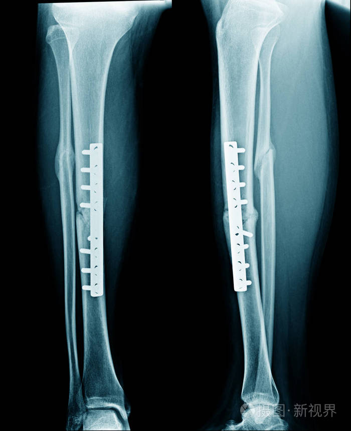 骨折腿双骨x线图像显示胫骨和腓骨骨折固定照片-正版