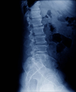 人脊柱侧视退行性变表现为蓝调椎管狭窄