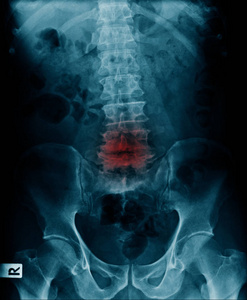 X线图像显示腰椎骨折椎体压缩性骨折L45水平