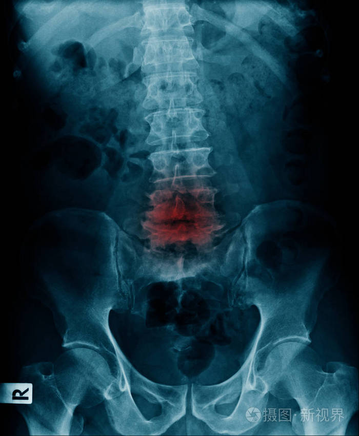 腰椎骨折x光片图片