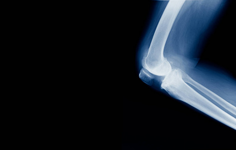 屈膝姿势膝关节高质量的X线膝关节横幅