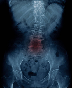 X线影像型病人脊柱L5S1型体病