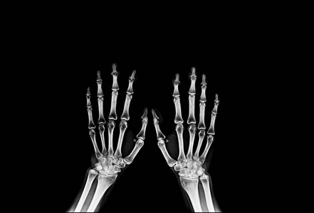 手和手指x射线图像