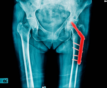 X射线髋关节置换术