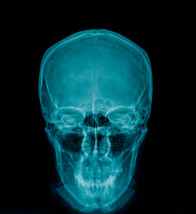 头骨x射线图像