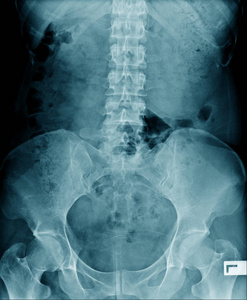 高质量X射线腰椎在蓝调Xrau老人图像显示脊椎病或退行性变及部分髋关节和骨盆骨