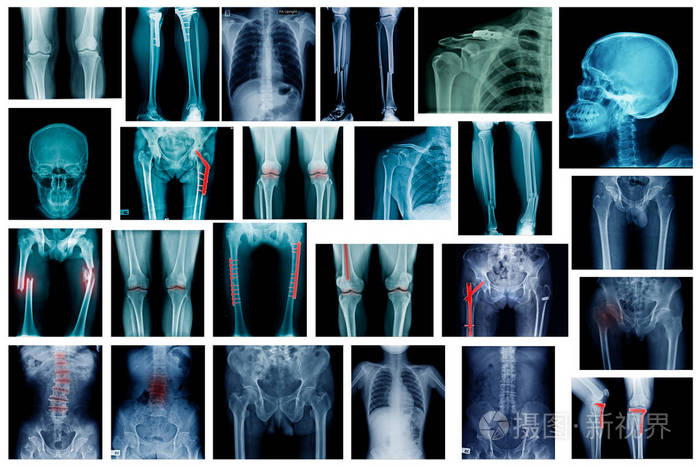 高质量的x射线图像显示人体的许多身体部位