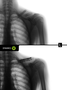 左锁骨的X射线。 在随后的金属结构固定中。 否定。