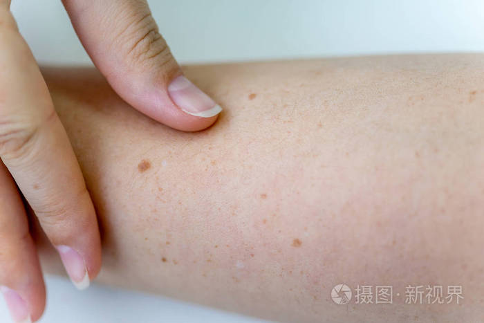 怎样治鸡皮肤色素痣(怎样治鸡皮肤色素痣图片)