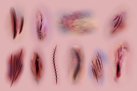 外伤缝合摆拍图片-外伤缝合摆拍素材-外伤缝合摆拍插画-摄图新视界