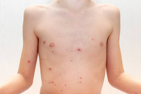 白种人男孩身体水痘病毒或水痘儿童气泡皮疹接近。 皮肤科和儿科概念