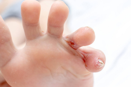 皮肤科和儿科的概念.真菌感染治疗.照片