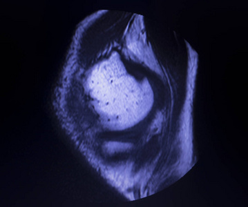 磁共振成像MRI膝后角内侧半月板撕裂最少的结果。