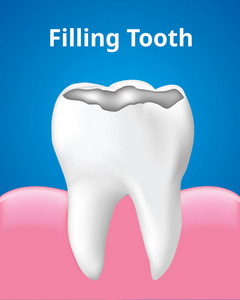 牙齿填充与牙龈牙齿护理概念现实设计插图矢量。