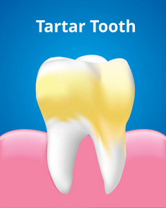 牙石牙与牙胶牙科护理概念现实设计插图矢量。
