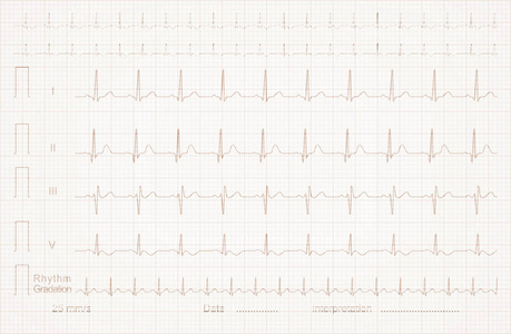 心电图心电图在线图纸上
