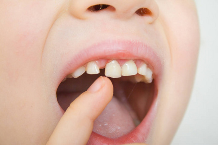 小女孩微笑着，用手指张开嘴摇晃着摇摇晃晃的乳牙。 第一颗磨牙。 保健牙科卫生和儿童概念。
