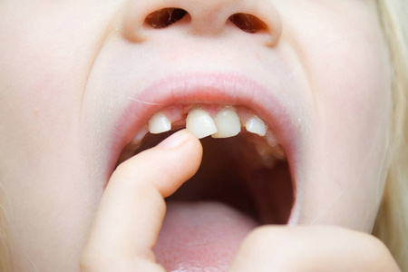 小女孩微笑着，用手指张开嘴摇晃着摇摇晃晃的乳牙。 第一颗磨牙。 保健牙科卫生和儿童概念。