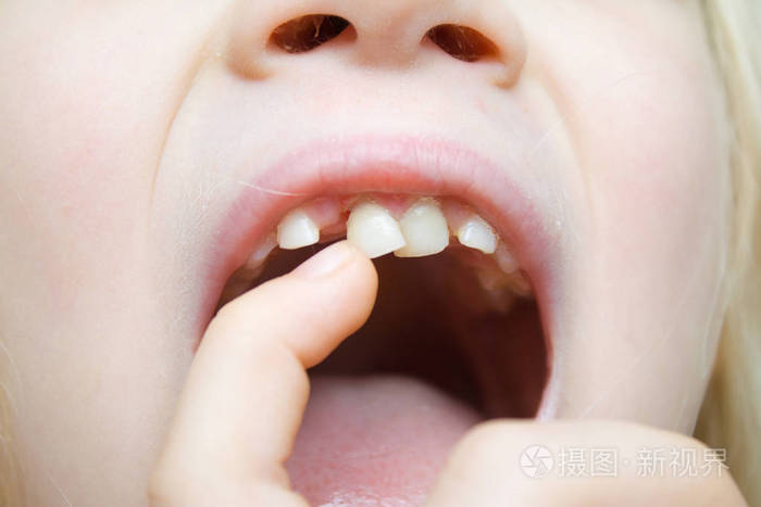 小女孩微笑着,用手指张开嘴摇晃着摇摇晃晃的乳牙. 第一颗磨牙.