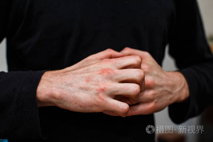 很多人的问题--手头有湿疹.黑色背景.人的皮肤发痒.寻常型银屑病