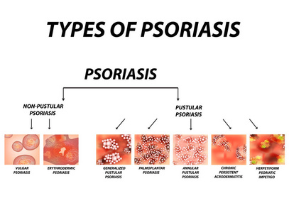 银屑病的类型。 脓疱而不是脓疱。 普通红皮病红皮病银屑病持续性肢端皮炎银屑病等。 湿疹皮肤病皮炎。 信息图表。 孤立背景