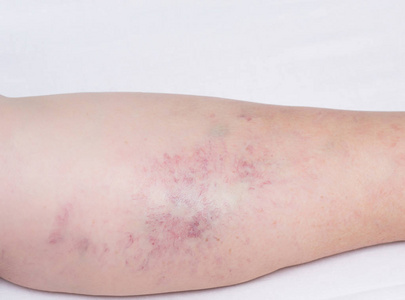 女性腿在白色背景与红色毛细血管, 静脉曲张在老年妇女的腿上, 特写