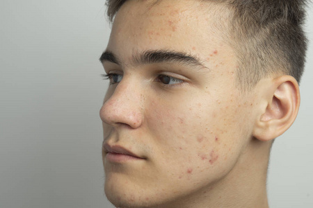 一个十几岁的青少年用一种方法来清洁他的脸，以消除痤疮和黑头