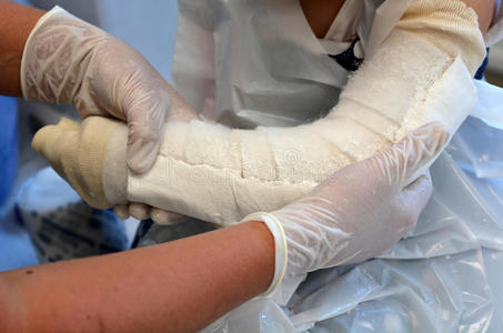 胳膊骨折的孩子照片