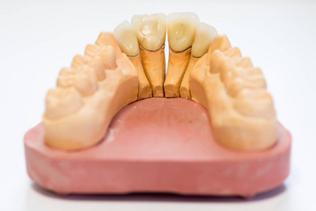 牙科石膏模型在牙科实验室办公室关闭。 石膏假牙与瓷牙隔离在白色背景复制空间