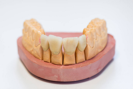 牙科石膏模型在牙科实验室办公室关闭。 石膏假牙与瓷牙隔离在白色背景复制空间