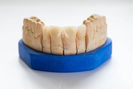 牙科实验室办公室牙科石膏模型特写。白底瓷牙石膏假牙仿造空间