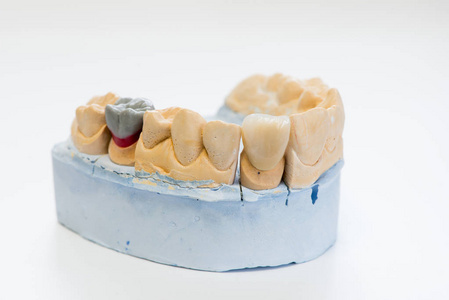 牙科实验室办公室牙科石膏模型特写。白底瓷牙石膏假牙仿造空间