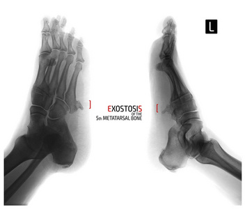 脚的X光片。第5跖骨外渗..否定。标记。