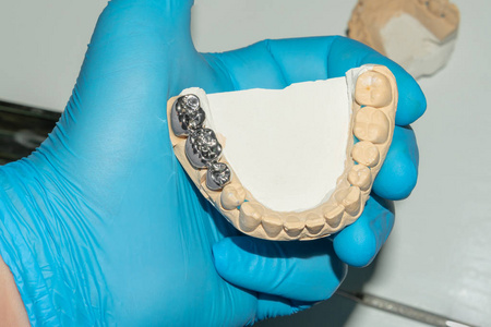 牙冠修复陶瓷牙冠修复牙齿烂根. 铸造牙科照片