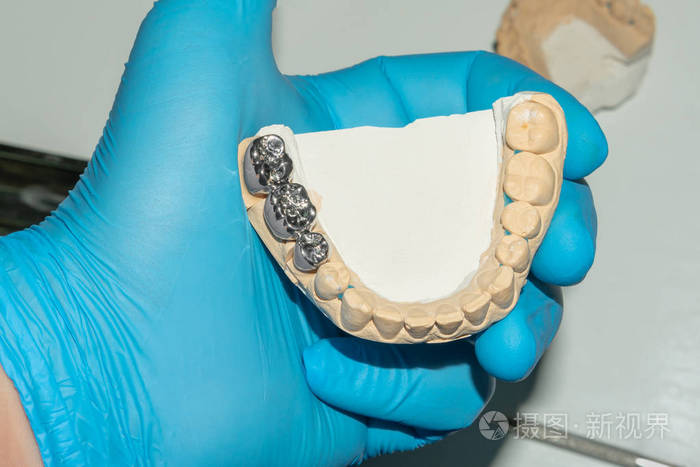 陶瓷牙冠修复牙齿烂根. 铸造牙科